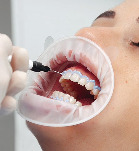 Patient receiving professional teeth whitening