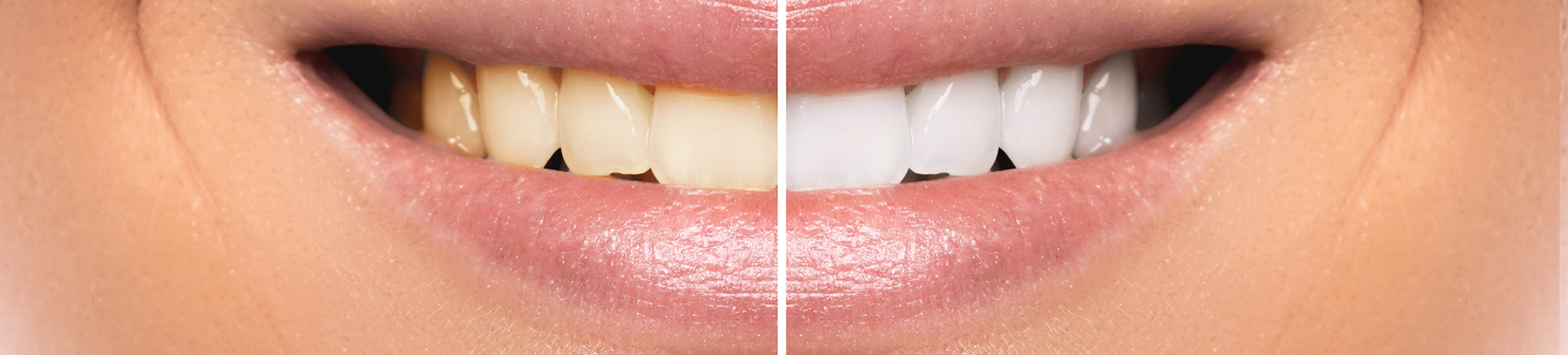Close up of smile before and after teeth whitening