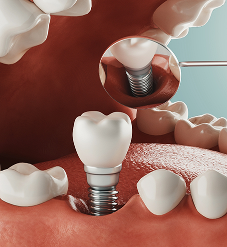 Illustration of dental implant being inserted into lower jaw