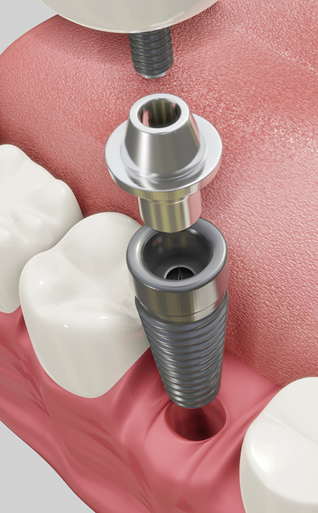 Dental crown and abutment being attached to dental implant