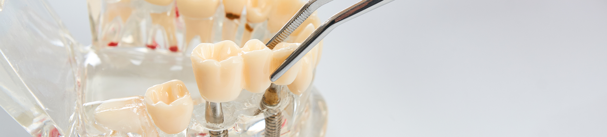 Attaching dental restoration to model of dental implant