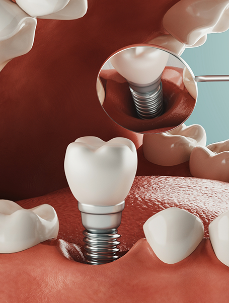 Illustration of dental implant with crown being placed in jaw