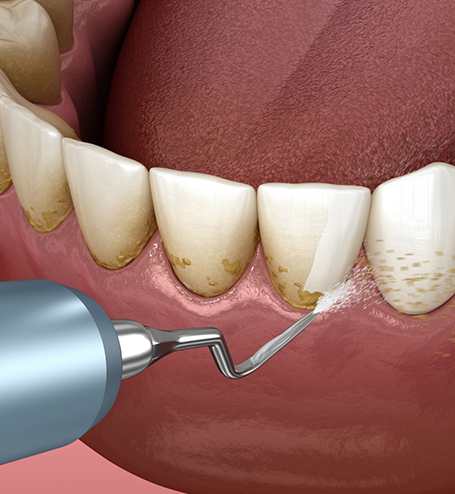 Illustration of scaling and root planing performed on lower teeth