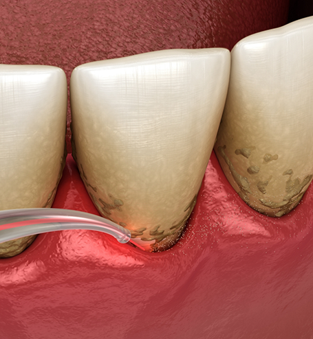 Illustration of laser used for gum disease treatment in Bozeman