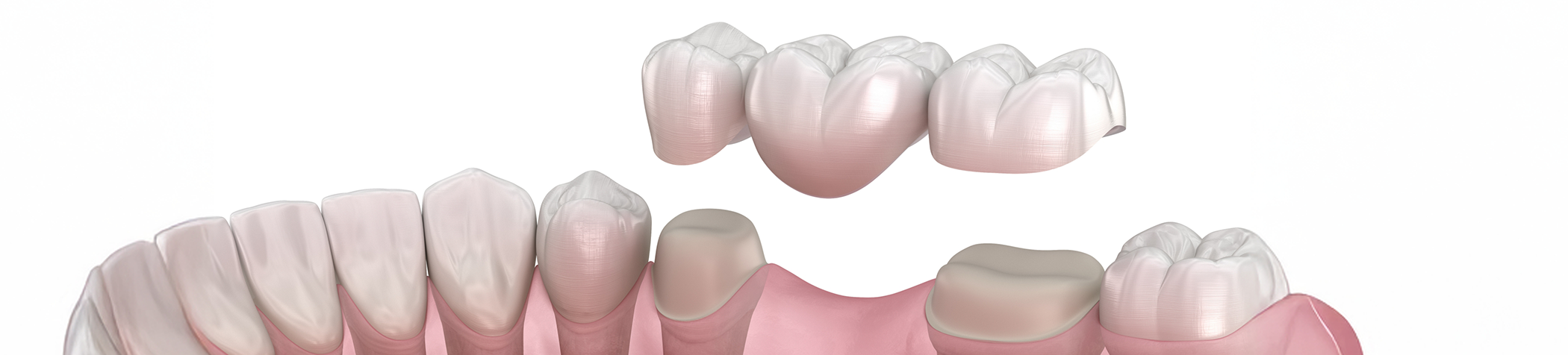 Illustration of dental bridge being placed