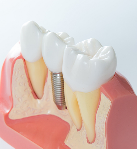 Model of dental implant