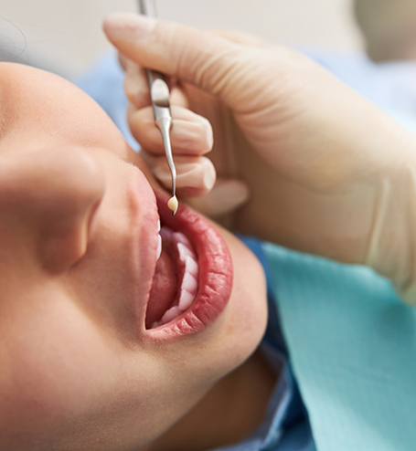 Patient opening mouth while dentist places filling