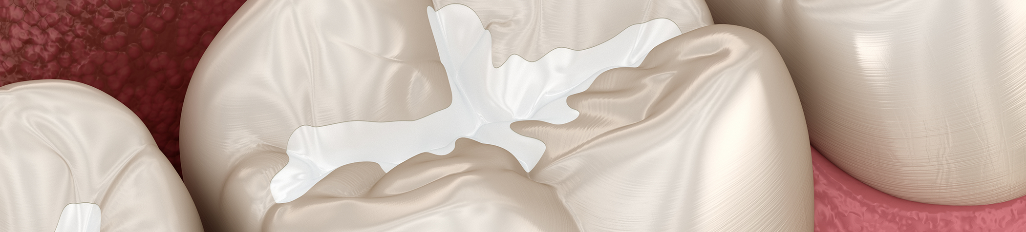 Illustration of tooth with tooth-colored filling