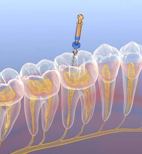 Illustration of root canal treatment