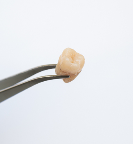 Close up of extracted tooth held by metal dental instrument