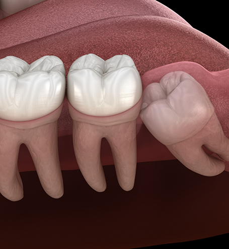 Illustration of impacted wisdom tooth